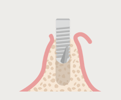 インプラント埋入手術 (1次手術)