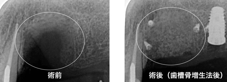 インプラントが困難と診断され治療を断念された方