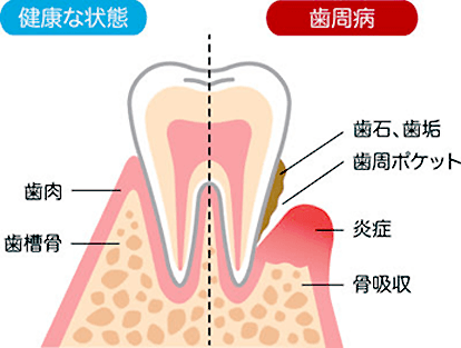 歯周病を予防できるかどうか